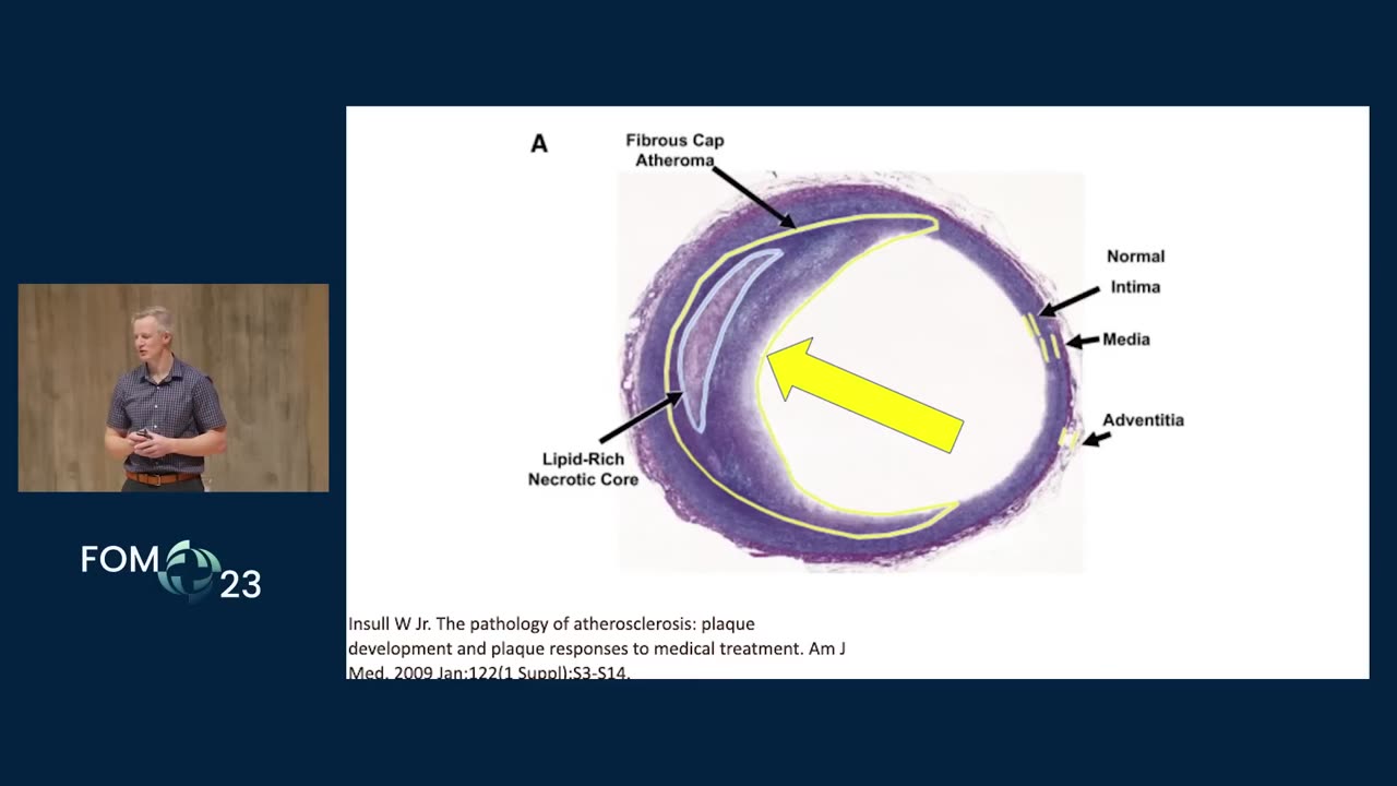 Decoding Atherosclerosis - The clotting theory and seed oil toxicity