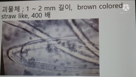 #백신접종자혈액속 괴물체#코로나진실규명의사회#이영미박사#MonstersInVaxedPatientsBlood