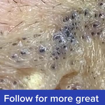 Pimple Popping Blackheads-DOSKf_nCS3k-480p-1655178156087