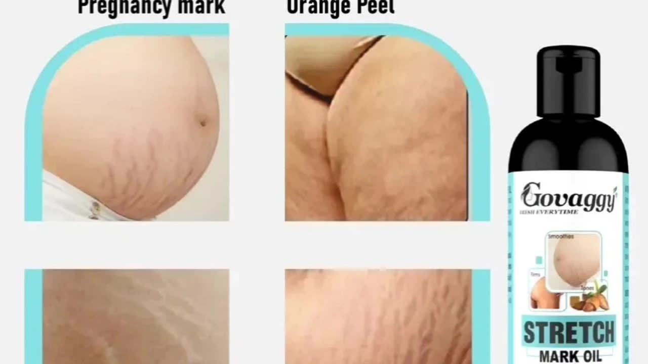 Stretch marks problem solving product