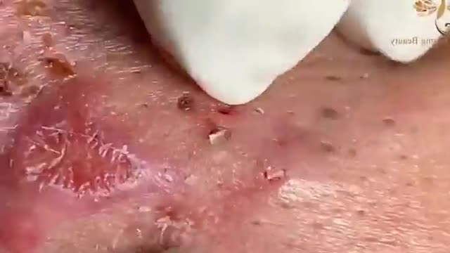 Amazing Big Deep Removal Of Blackheads