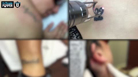 Laser Tattoo Removal