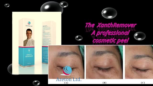 Syringoma Removal using XanthRemover 70% Glycolic acid Peel