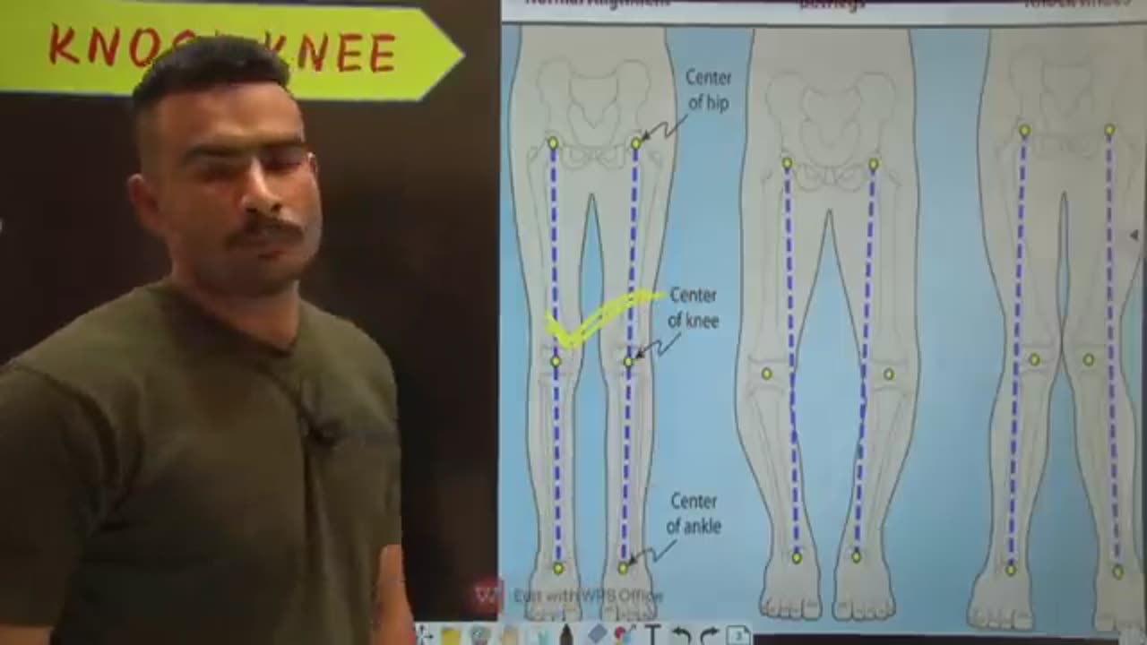 Knock knee problems solve into 1 months