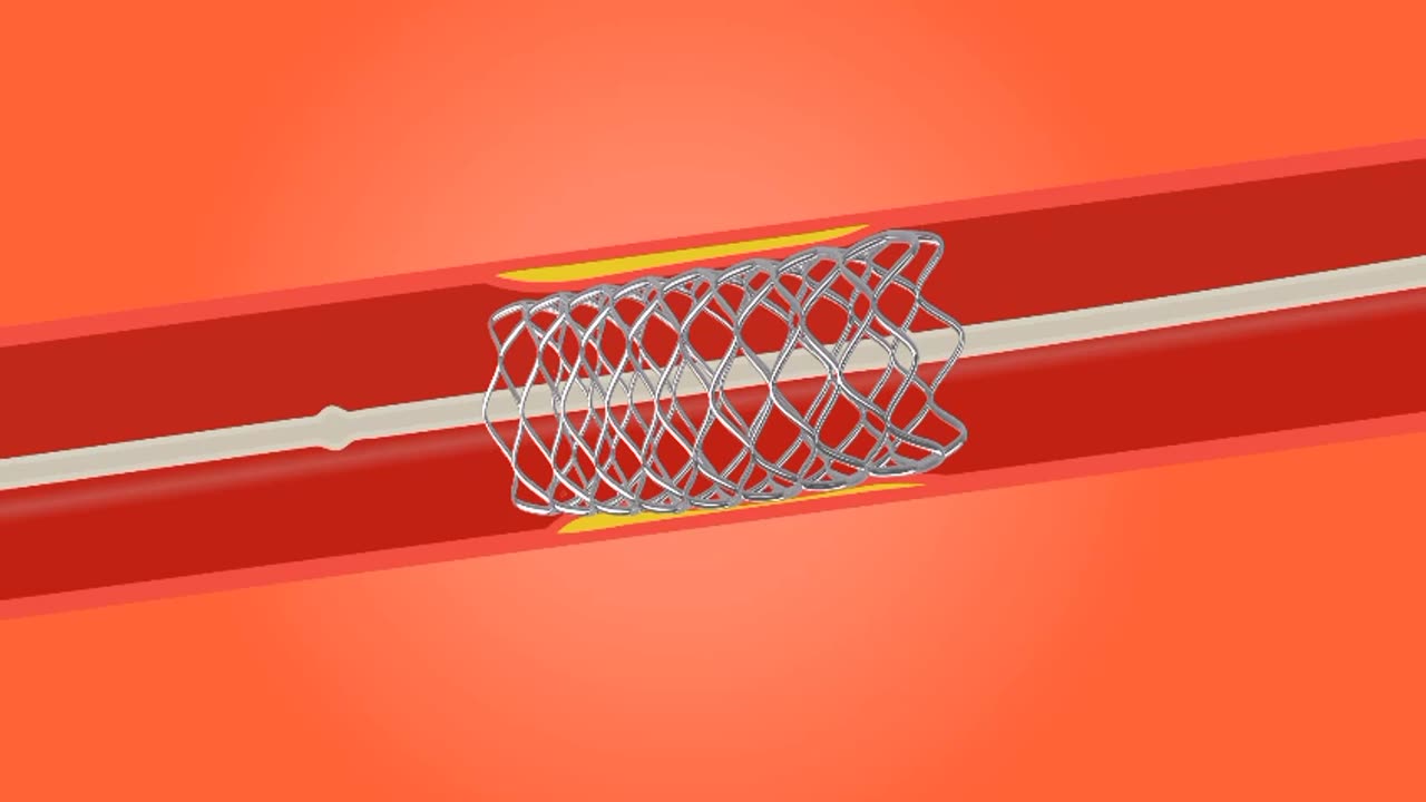 angioplasty and stent placement for treatment of heart disease, stroke and atherosclerosis