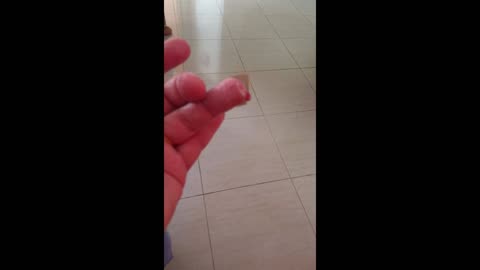 Cauterization of Finger Abscess