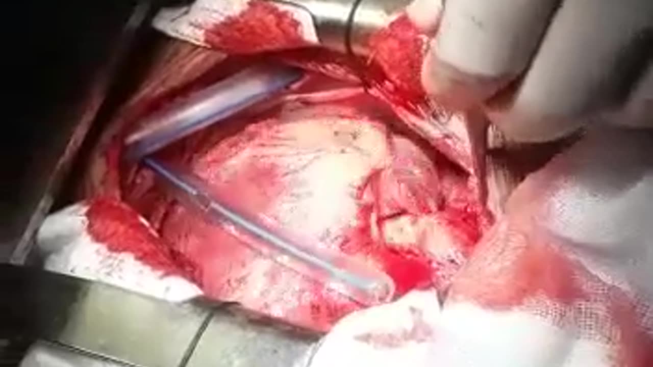 US 18years old student Heart transplant