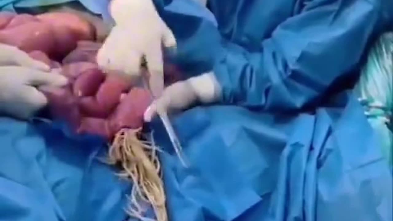 Stomach-Churning Surgery: Doctor Removes Nest of Worms from Patient’s Intestines