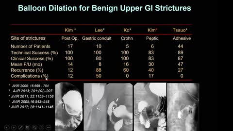 No. 13- Estenosis Benignas GI superiores: Dilatación con Balón y Colocación de Stents.