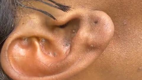 Ear blackheads