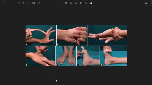 ST5.30 year old man with easy bruising.mp4