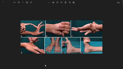 ST5.30 year old man with easy bruising.mp4