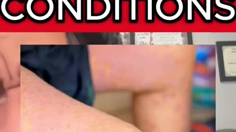 Skin conditions