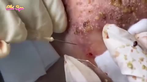 Blackheads & Milia, Big Cystic Acne Blackheads Whiteheads Removal #satisfying #pimple #blackheads