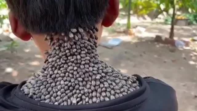 This child is covered in skin chips