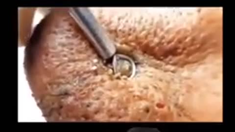 Blackheads Removal From Nose, Satisfying Video, Acne Cleaning