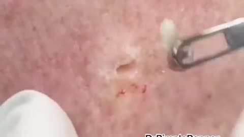 WHAT is this on the arm？ Extractions with Dr. Pimple Popper #shorts #dpow