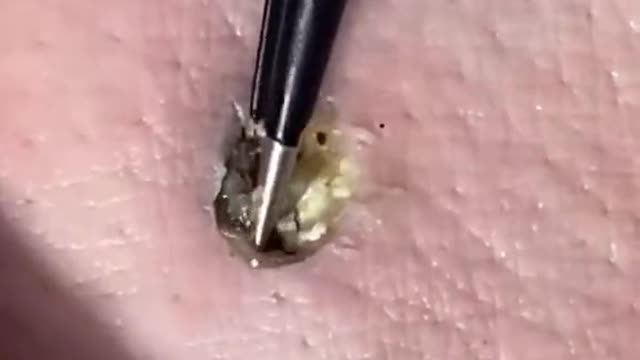 Black head removal from the skin