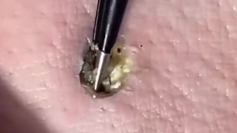 Black head removal from the skin