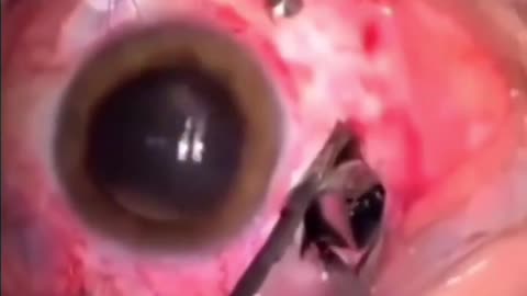 Surgeon Removes Shrapnel From Eye