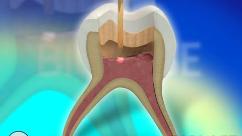 Dental Restoration with Waterlase Laser Dentistry