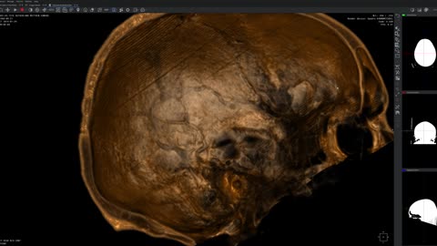 CT Scan 3D Model Of Skull Shows Cochlear Devices, Wiring Upon Temples