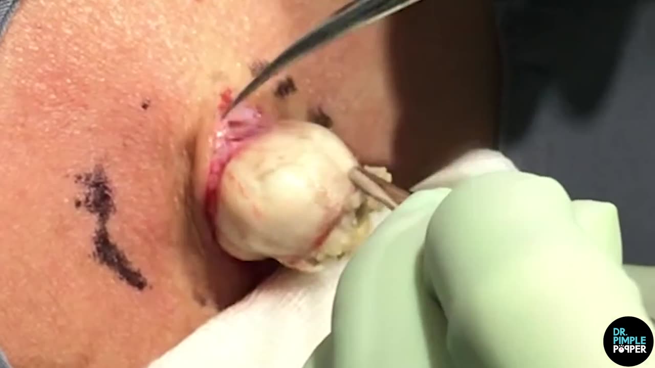 A Beautiful Bulb of Garlic Cyst