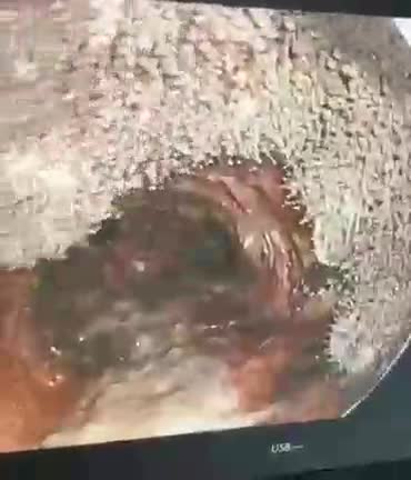 SERIOUS VACCINE ADVERSE SIDE EFFECTS. SEVERE DAMAGE TO LUNGS AS WELL.