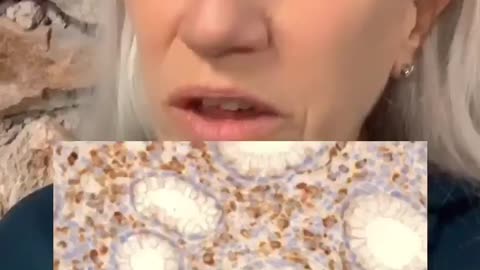They are finding spike proteins from the jab right in the middle of cancer cells