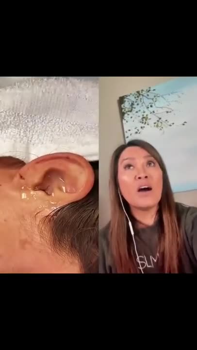 Live Insect In Ear! Dr Pimple Popper Reacts