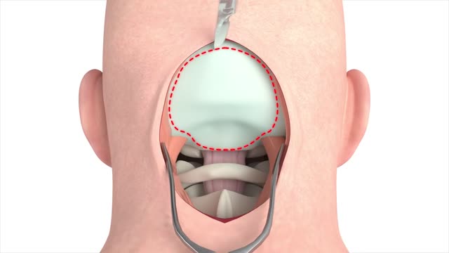 Craniectomy Surgical Procedure 3D Animation