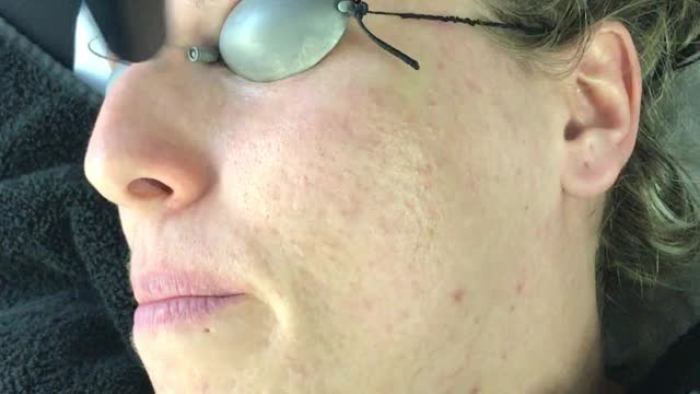 Acne treatment using 104 Q Switch Laser