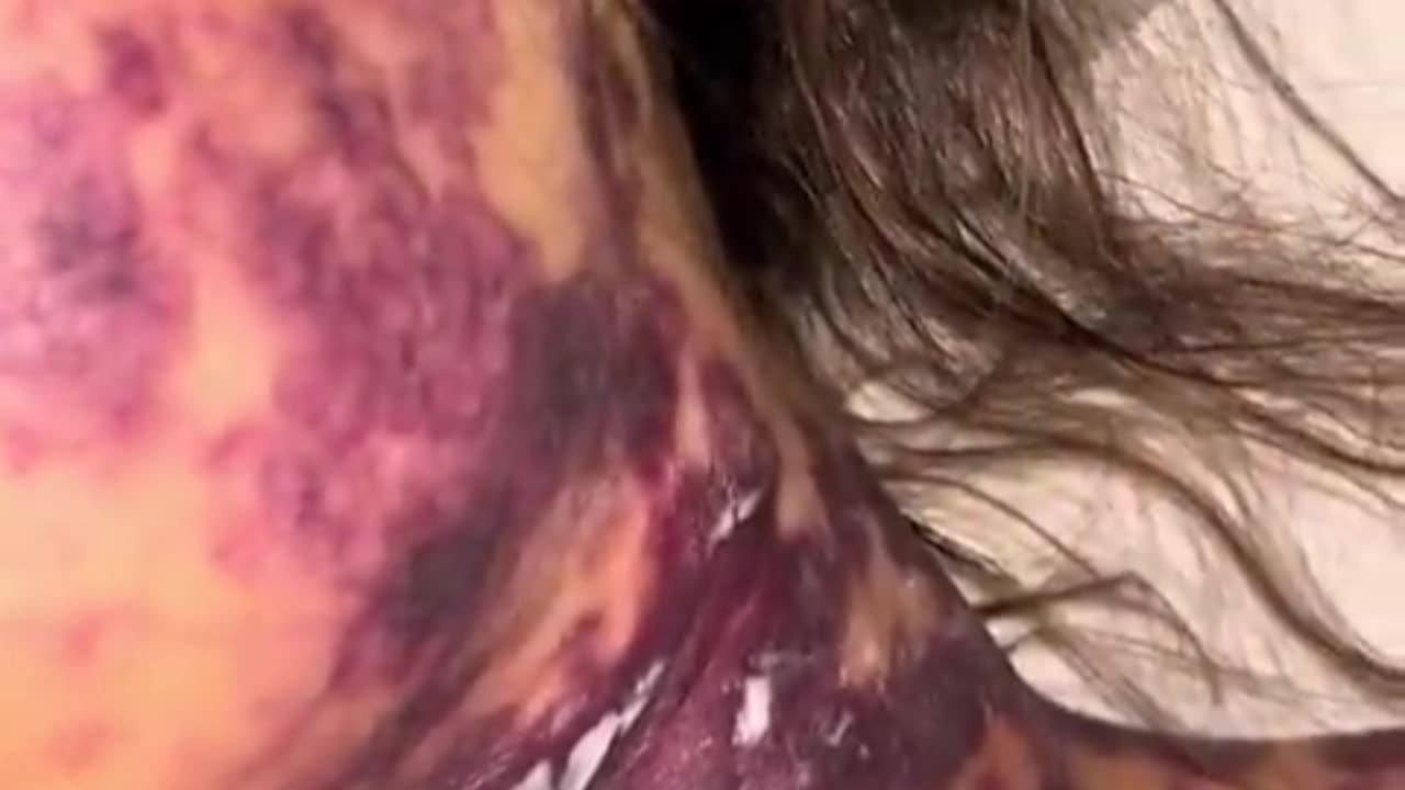 Woman forced to get meningitis, pneumonia and tetanus vax all given at once had a reaction