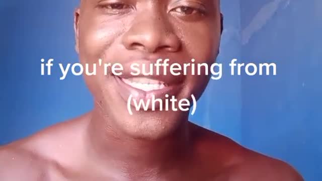 Girls Those suffering from white