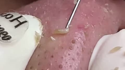 Blackheads Satisfying videos