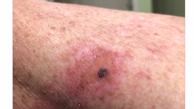 Video Testimonial: Irregular mole removed with the universal antidote. MMS