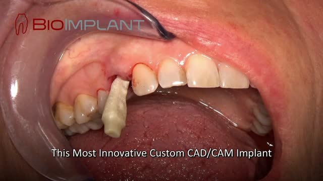 ***LIVE VIDEO: IMMEDIATE IMPLANT PLACEMENT (RAI)***