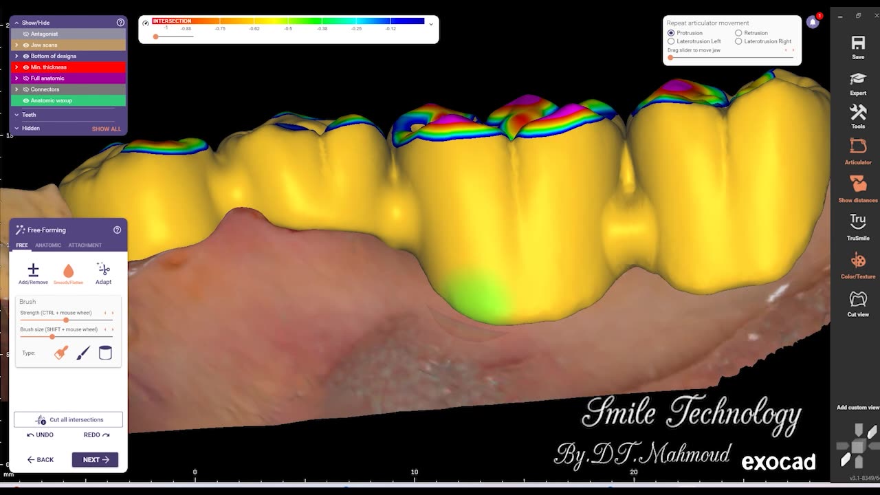 #design #naildesign #dental #dentaldesign #exocadexpert