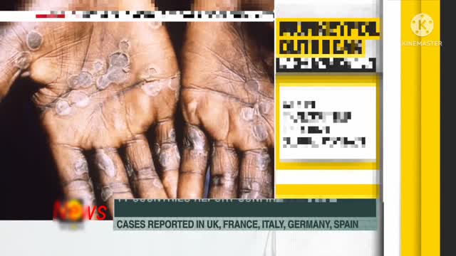 Monkeypox Outbreak_ 11 countries report confirmed