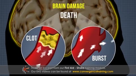 First Aid - Stroke Training