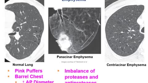 Obstructive lung diseases