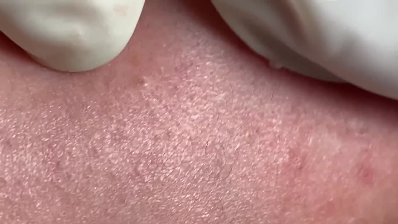 Acne Treatment Huong Da Nang#002