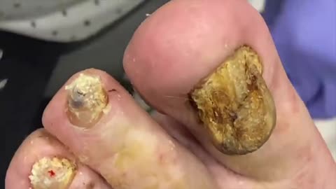 MINDBLOWING TOENAILS | HOW TO PREVENT FUNGUS