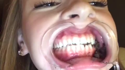 Girl eating chocolate with dental mouth opemner