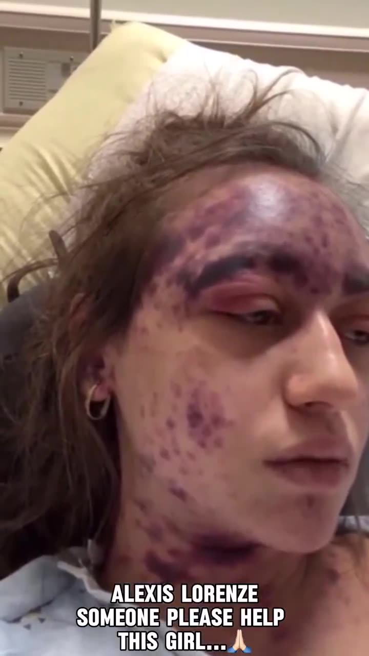 “常規疫苗接種災難01”來自加州的Alexis Lorenz的求救，其可怕的影片在“X”上瘋傳！她在一次接種三種疫苗（腦膜炎、肺炎鏈球菌、破傷風疫苗）後，出現了強烈的“不良反應”…