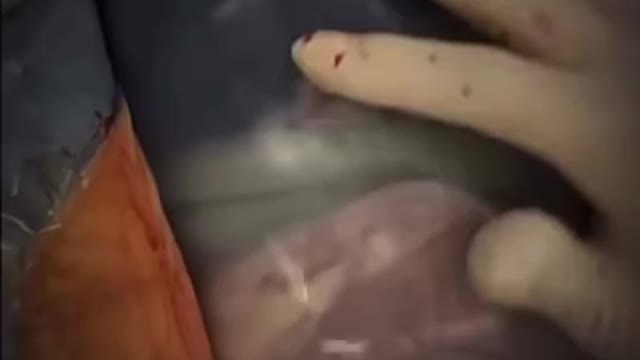 BIRTH - MOST AMAZING FOOTAGE OF BABY STILL INSIDE AN INTACT AMNIOTIC SAC