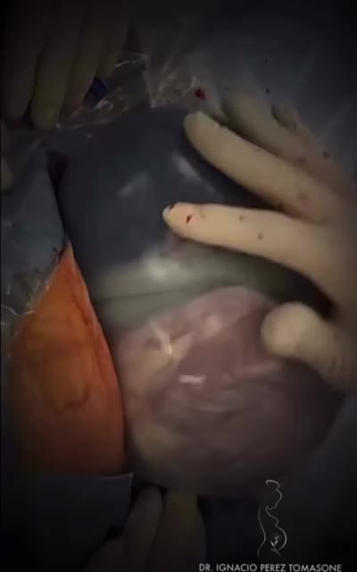 BIRTH - MOST AMAZING FOOTAGE OF BABY STILL INSIDE AN INTACT AMNIOTIC SAC