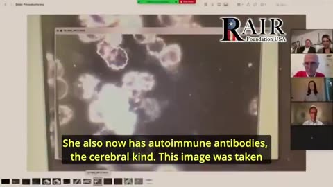 Duitse pathologen vinden bewegende metalen in overleden gevaccineerde mensen tijdens de autopsie.