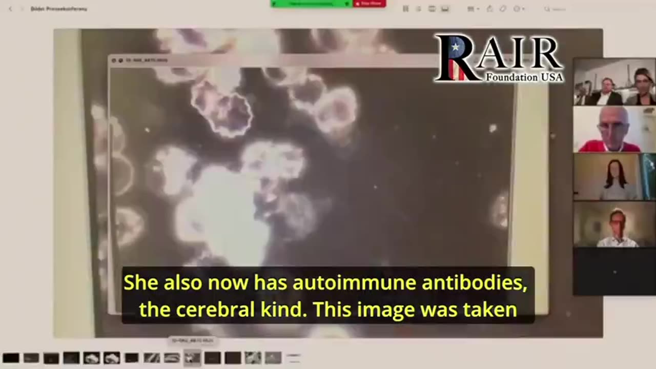Duitse pathologen vinden bewegende metalen in overleden gevaccineerde mensen tijdens de autopsie.