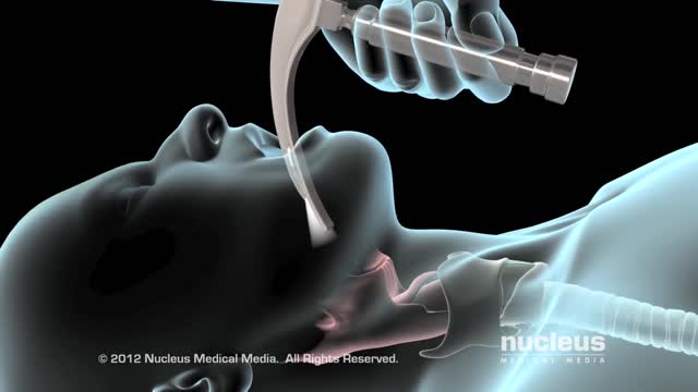 Covid 19 Intubation and Mechanical Ventilation